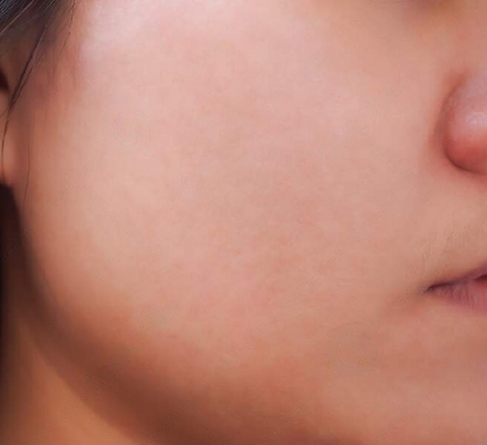 1680772543_acne_treatment.png