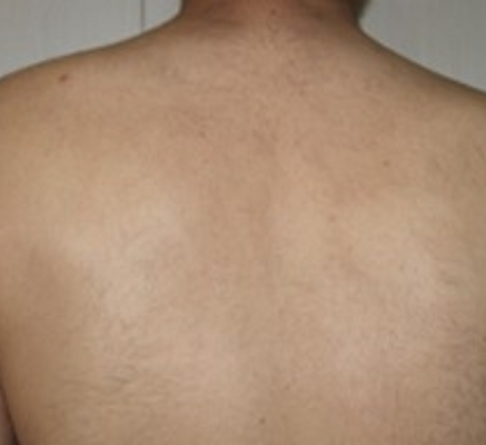 1680851313_diode_laser_for_hair_removal_(2).png