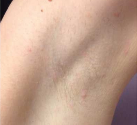 1680851449_laser_hair_remova_(2).png