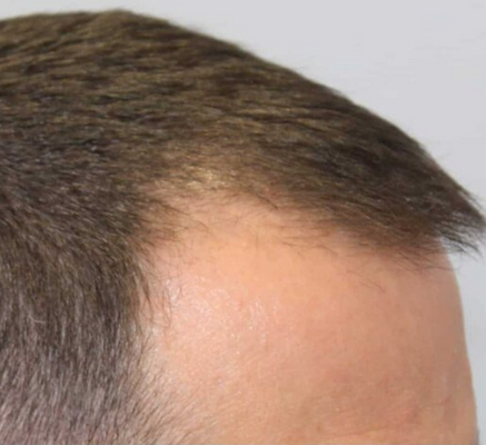 1688552404_prp_therapy_treatment_(2).png