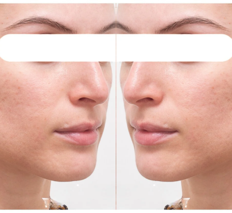 1747364962_fractional-rf-skin-resurfacing-treatment-after.png