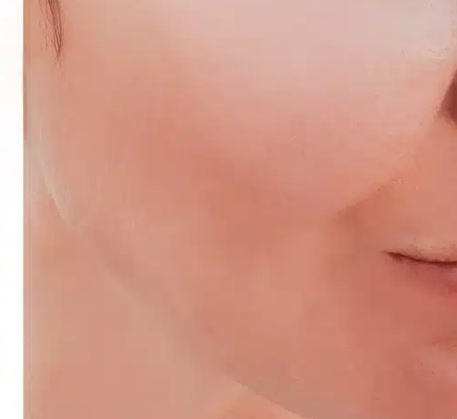 1747365009_fractional-laser-resurfacing-after.png