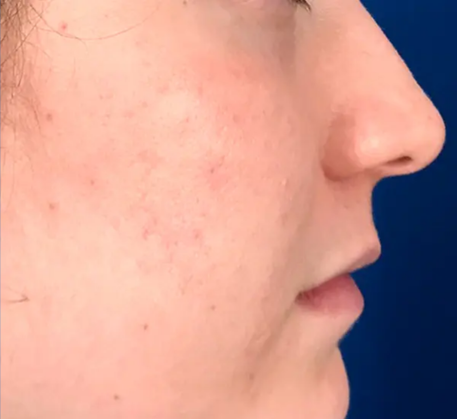1747368196_laser-photofacial-after.png