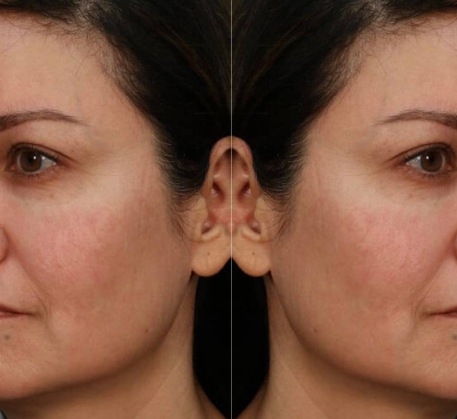 1747368390_hyaluronic-acid-infusion-facial-after.png