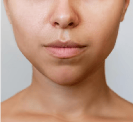 1747368458_dermal-fillers-after.png