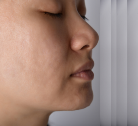 1747368870_acne-scar-after.png
