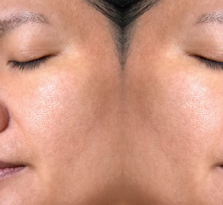 1747369017_chemical-peel-after.png