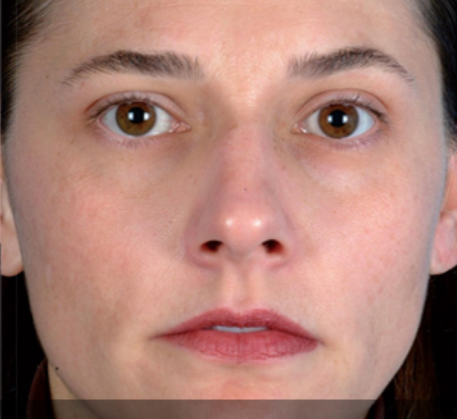1747369130_microdermabrasion-after.png