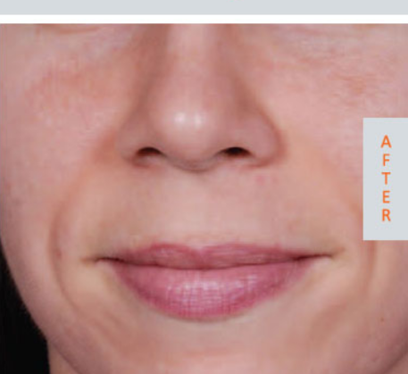 1747369175_pigmentation-after.png