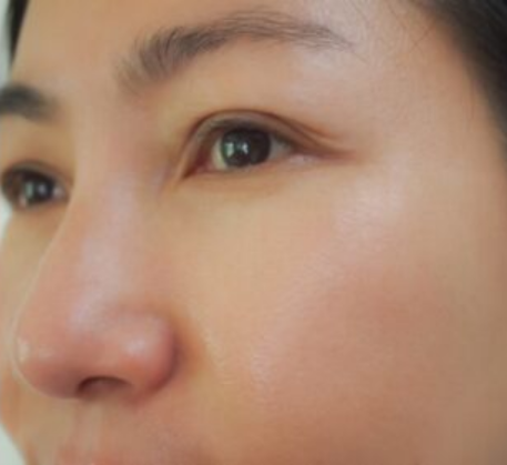 1747369263_mesotherapy-after.png
