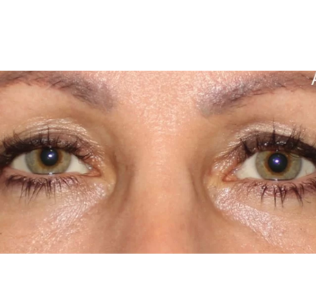 1747369351_under-eye-after.png