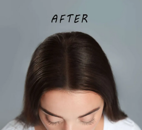 1749620633_mesotherapy-hair-treatment-after.png