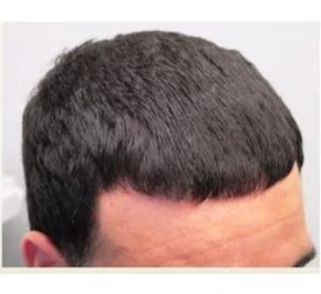 1749621108_laser-hair-regrowth-after.png