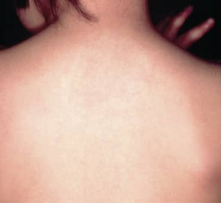 1749621650_birthmark-removal-after.png