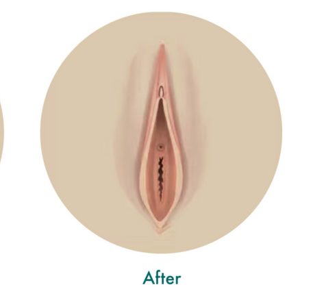 1749621861_vaginal-rejuvenation-treatment-after.png