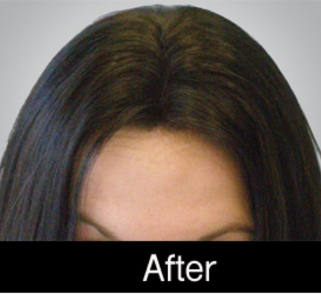 1749622179_prp-hair-treatment-after.png