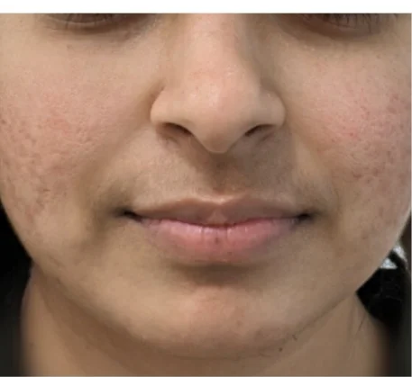 dermatologist-in-thane-after.webp
