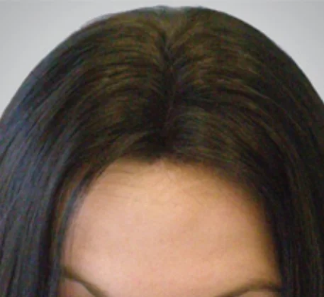 hair-care-treatments-in-thane-after.webp
