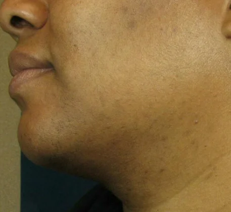 laser-treatment-in-thane-after.webp