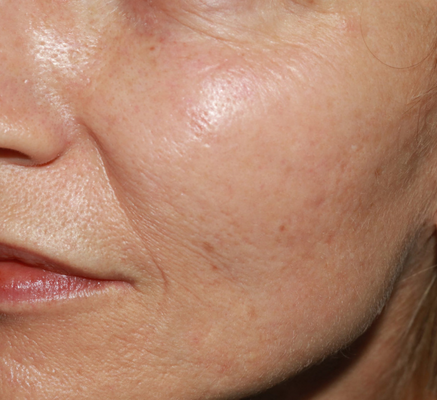 microneedling_(2).png