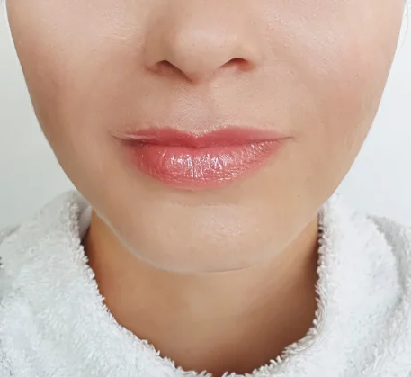 skin-care-treatment-in-thane-after.webp