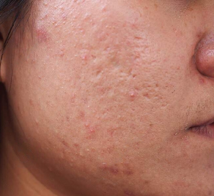 1680772543_acne_treatment1.png