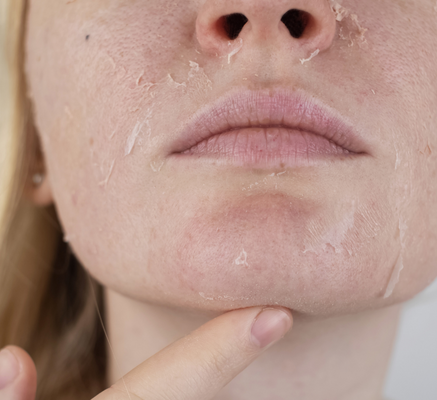 1680775667_hydrafacial.png