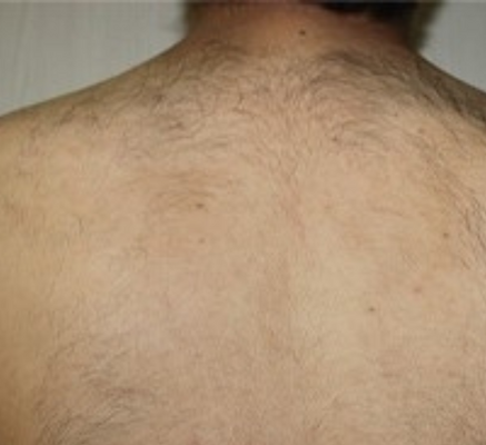 1680851313_diodelaser_for_hair_removal.png