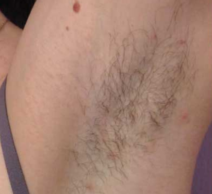 1680851449_laser_hair_removal.png