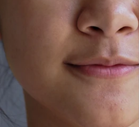 1747364835_laser-slin-lightening-and-brightening-treatment-before.png