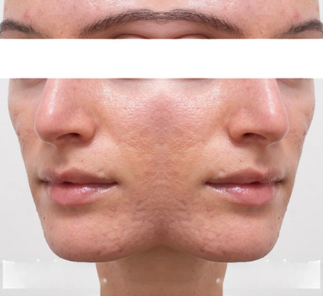 1747364962_fractional-rf-skin-resurfacing-treatment-before.png