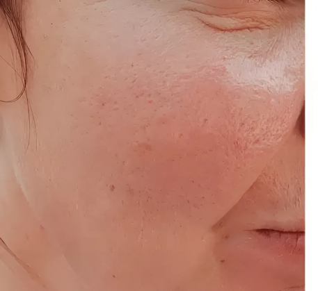 1747365009_fractional-laser-resurfacing-before.png
