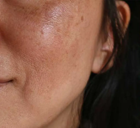 1747367583_melasma-treatment-before.png