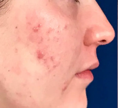 1747368196_laser-photofacial-before.png
