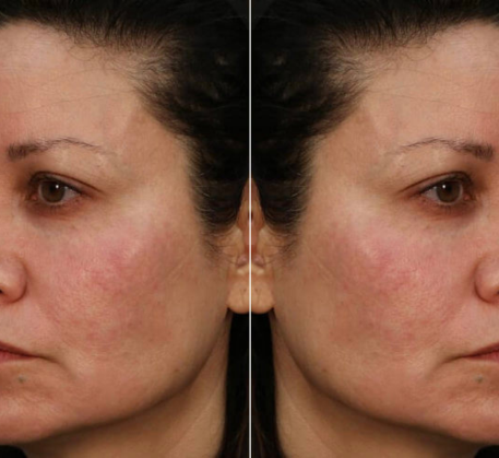1747368390_hyaluronic-acid-infusion-facial-before.png
