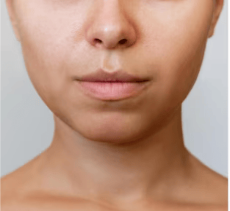 1747368458_dermal-fillers-before.png