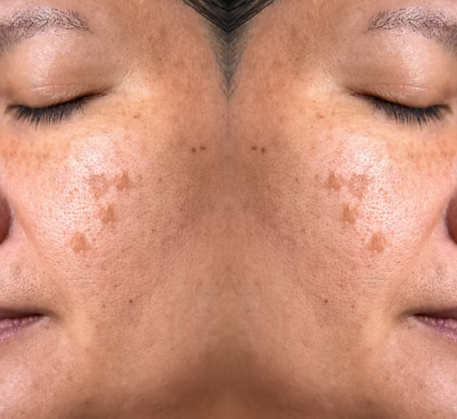 1747369017_chemical-peel-before.png