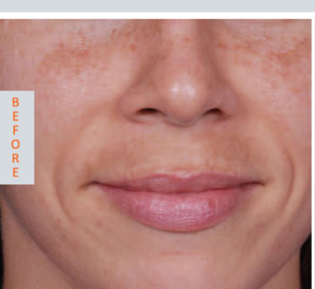 1747369175_pigmentation-before.png