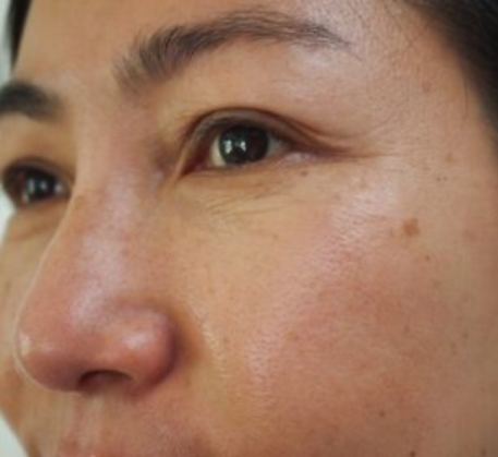 1747369263_mesotherapy-before.png