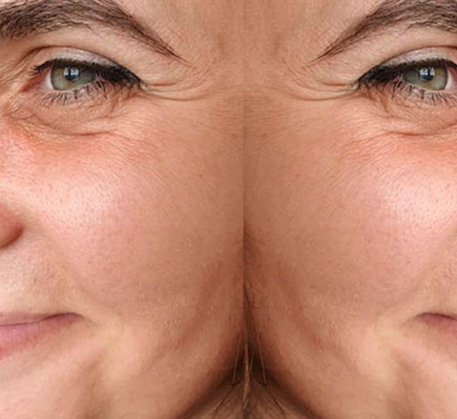 1747369303_face-lifting-before.png
