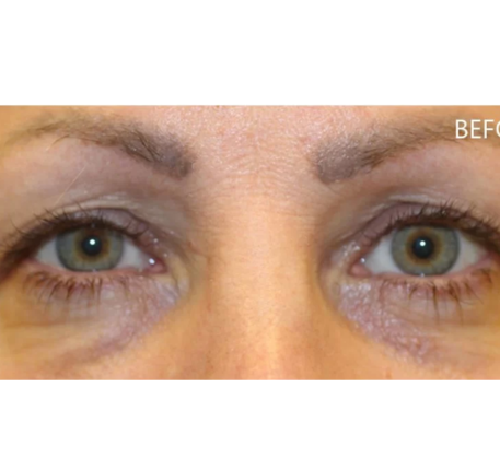 1747369351_under-eye-before.png