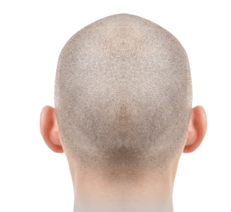 1749619900_fue-hair-transplant-before.png