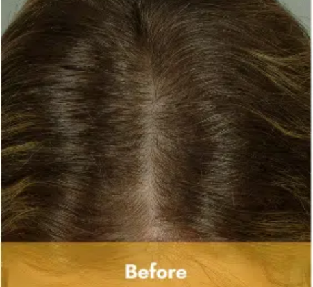 1749620281_stem-cell-therapy-before.png
