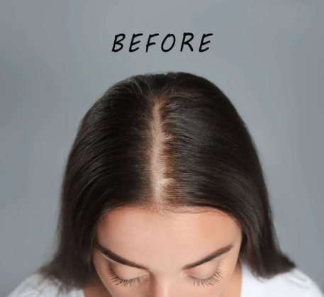 1749620633_mesotherapy-hair-treatment-before.png