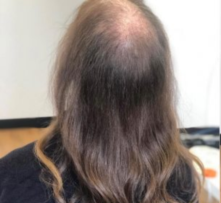 1749620956_hair-loss-treatment-before.png