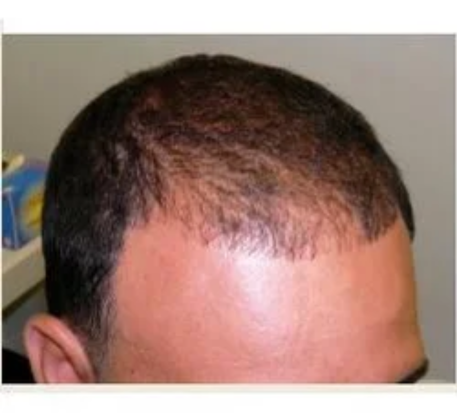 1749621108_laser-hair-regrowth-before.png