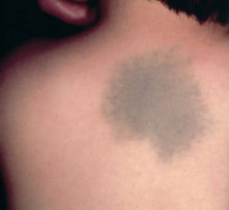 1749621650_birthmark-removal-before.png