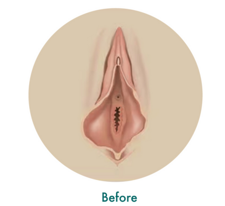 1749621861_vaginal-rejuvenation-treatment-before.png