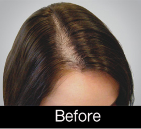 1749622179_prp-hair-treatment-before.png