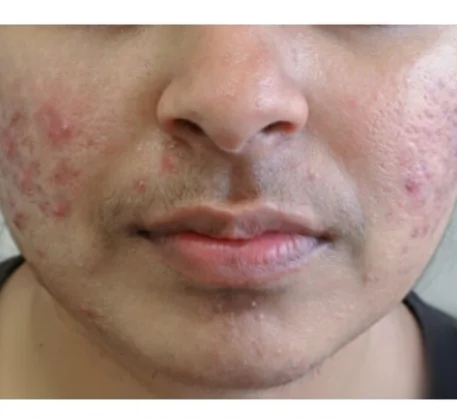 dermatologist-in-thane-before.webp